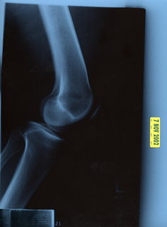 Adam's knee X-ray 2