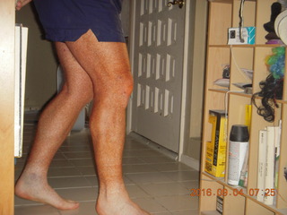 after knee operation + Adam walking with cane