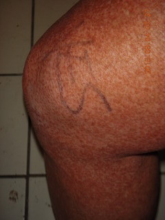 two days after my knee surgery