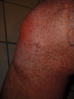 two days after my knee surgery (my cat Max)