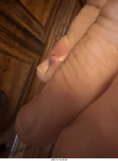 Adam's infected finger