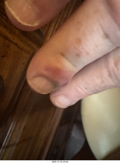 Adam's infected finger