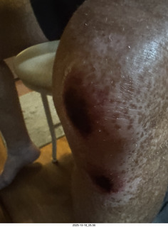 Adam's infected finger