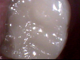 my new crown close-up