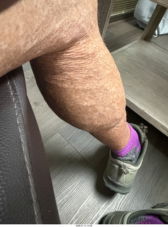 veins on my calves