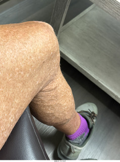 veins on my calves